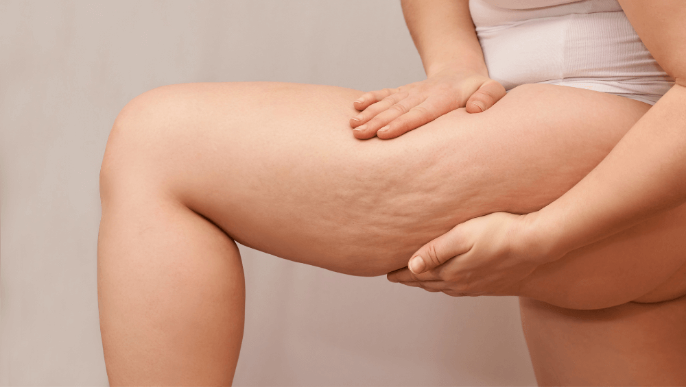 Cómo tratar la celulitis con Ballancer