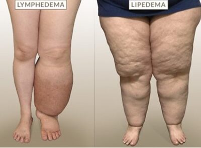 Diferencia entre obesidad, lipedema y linfedema