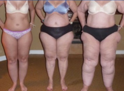 Diferentes etapas de progresión del lipedema