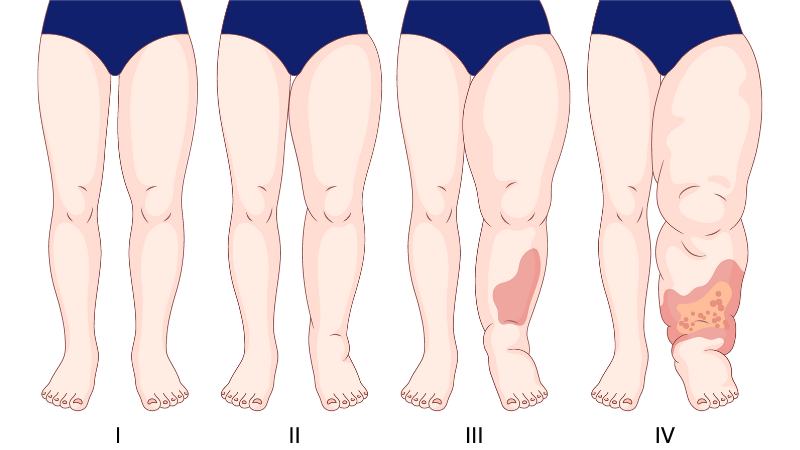 Grados de linfedema en casos de cáncer de mama Grados de linfedema en casos de cáncer de mama