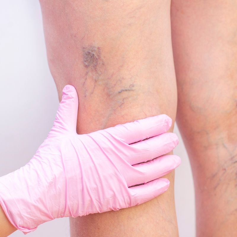 Causas de las venas varicosas Causas de las venas varicosas