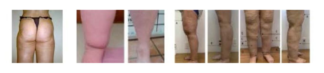 Lipedema: Descripción clínica y clasificación