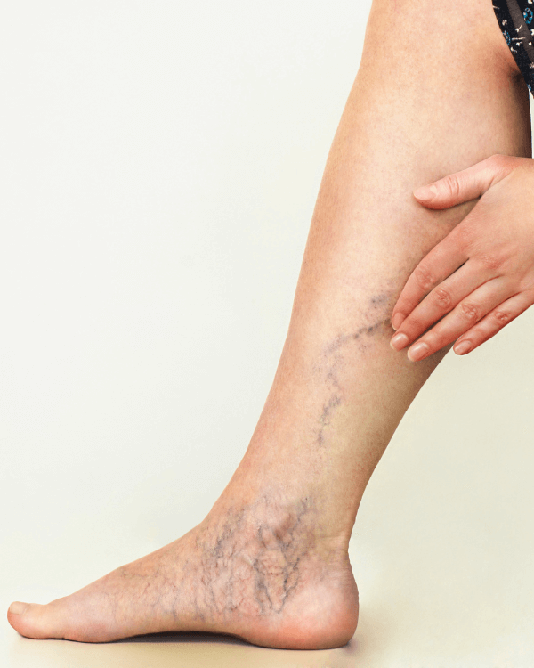 Lymphapress presoterapia tratamiento venas varicosas linfedema Lymphapress presoterapia tratamiento venas varicosas linfedema