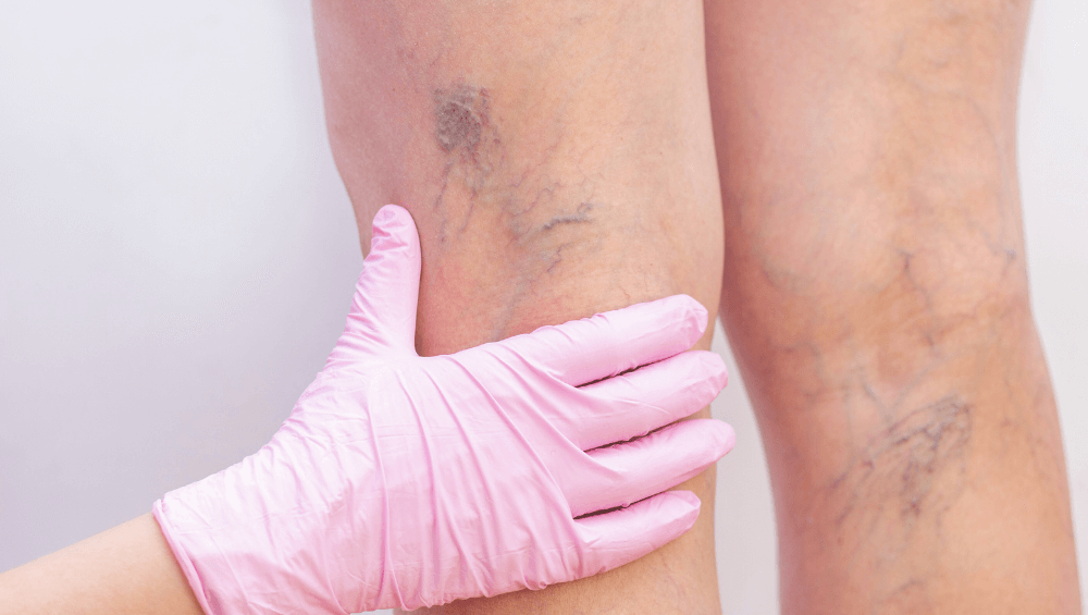 Arañas Vasculares: Causas, tratamiento y cómo prevenirlas con Presoterapia
