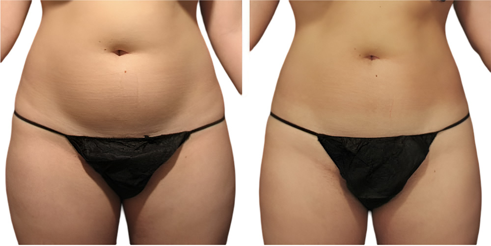 Presoterapia en abdomen antes y después