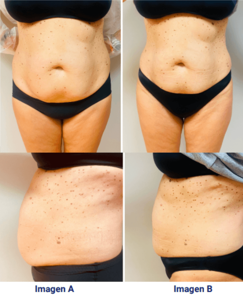 Caso real: Cómo aplicar Ocarine® en un caso de celulitis en abdomen