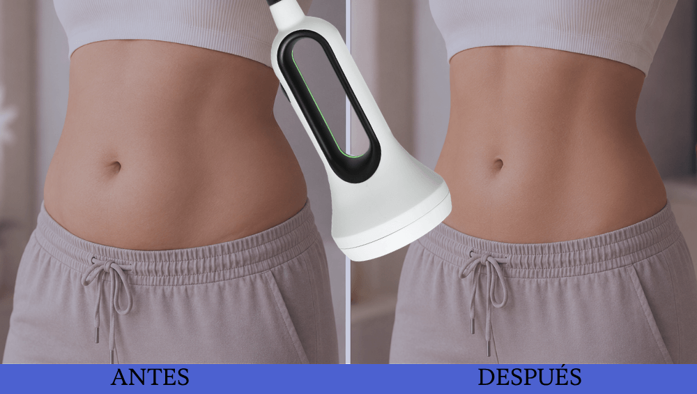 Cómo eliminar la grasa rebelde de abdomen y cartucheras con Ocarine®