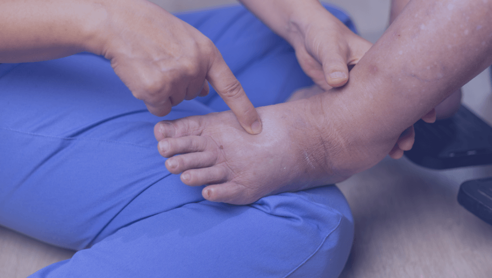 ¿Por qué Lympha Press es el estándar médico para tratar el linfedema?
